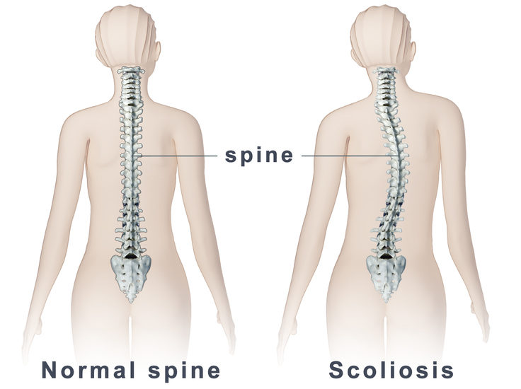 5 early signs of scoliosis that you should be aware of