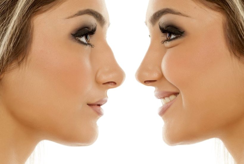 7 things to avoid after rhinoplasty