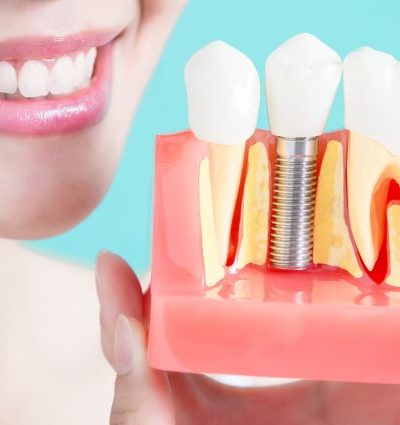 a quick guide to dental implants