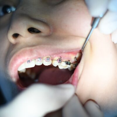 5 Advantages Of Orthodontic Tracings In Treatment Planning