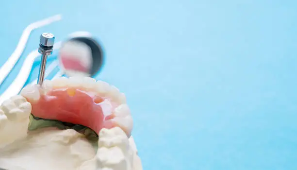 6 tips for choosing between dentures and implants