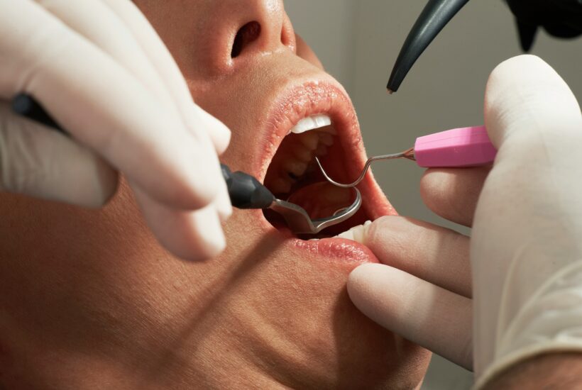 6 benefits of fluoride and sealants in preventive dentistry