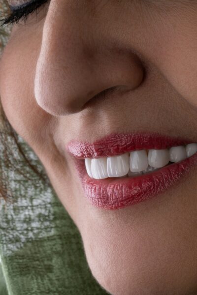 how smile design plays a key role in successful dental implant results