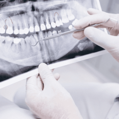 Understanding The Role Of X Rays In General Dental Care