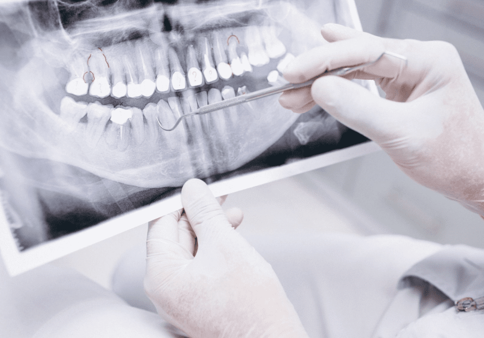 understanding the role of x rays in general dental care